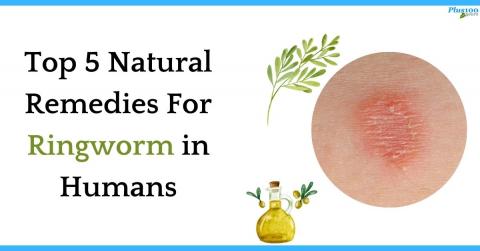 natural remedies for ringworm 