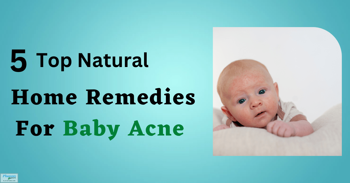 Home Remedies for baby acne